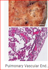 تم نشر مقالة علمية للتدريسي في قسم تقنيات التخدير الدكتور علي جاسم محمدالخفاجي بعنوان Pulmonary Vascular Endothelialitis, Thrombosis, and Angiogenesis in Covid-19