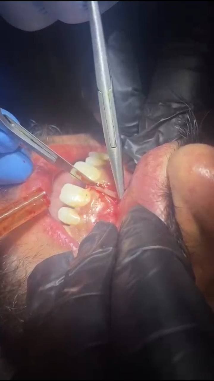 Performing the frenulum cutting operation (FRENECTOMY) in the clinics of the Department of dentist