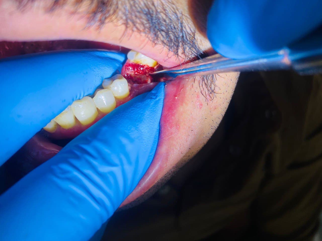 A dental extraction procedure for one of the auditors in the dental clinics within the Al-Mustaqbal University College