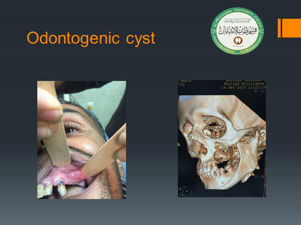 The Department of Dentistry holds an electronic scientific symposium entitled (Odontogenic cyst)
