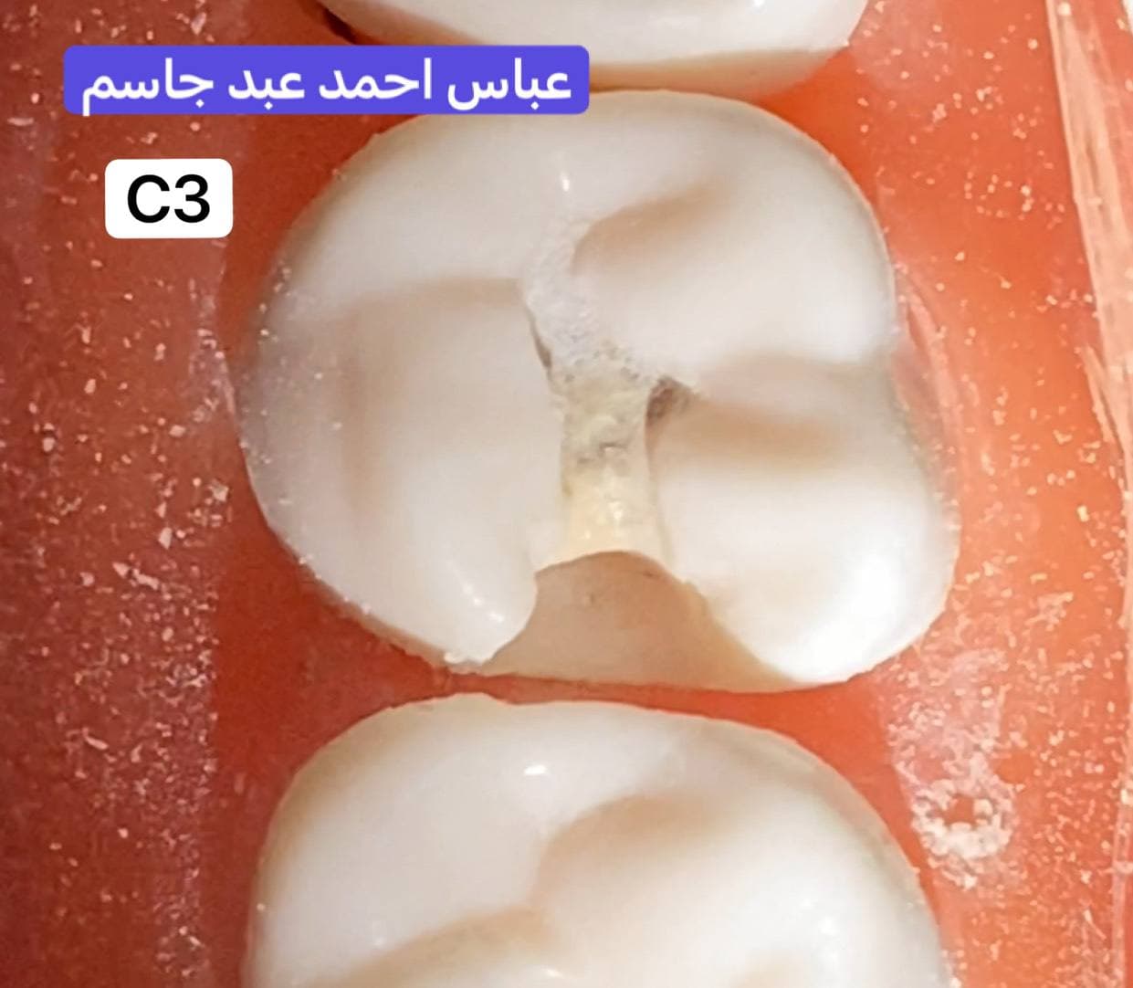 The Department of Dentistry is holding a competition for students of the third stage in the subject of dental treatment