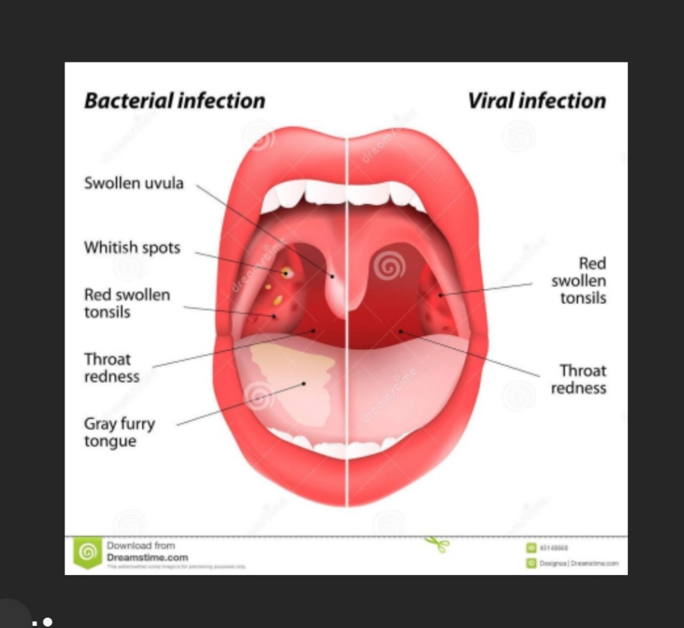 The difference between viral and bacterial infection  (م.م ريام عبد الخضر محمد )