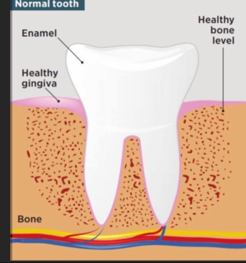 The effect of tooth decay on the health of the body (م.م ريام عبد الخضر محمد)
