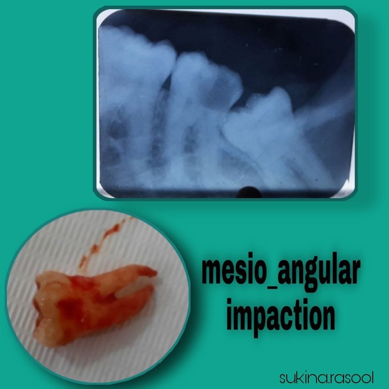 Part of the creativity of student Sakina Rasool, the fifth stage in the process of tooth extraction