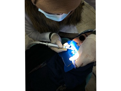 Direct anterior composite