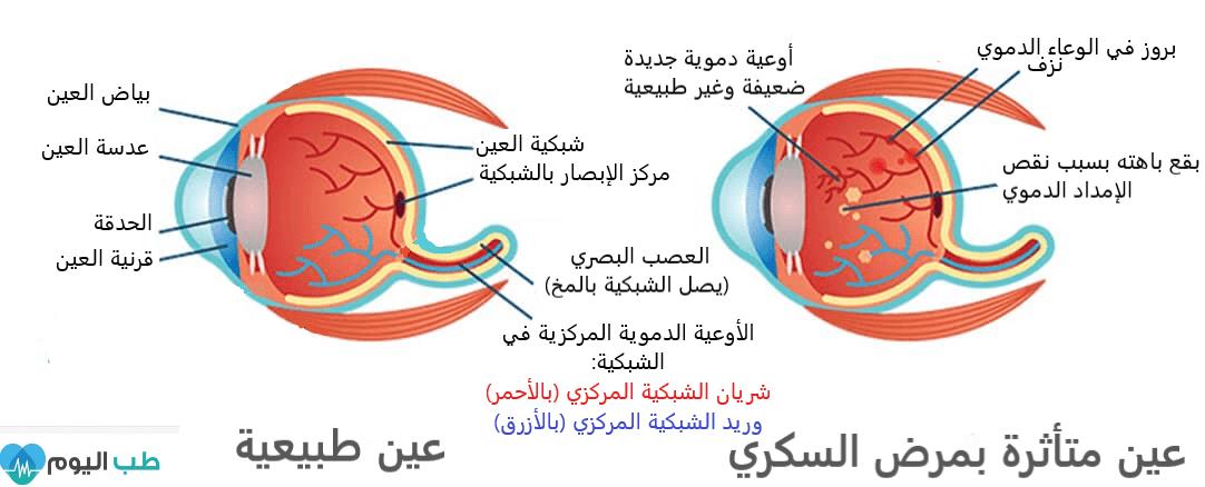 مقالة علمية للتدريسية م.م وفاء حفظي حمدي (اعتلال الشبكية السكري (Diabetic Retinopathy))