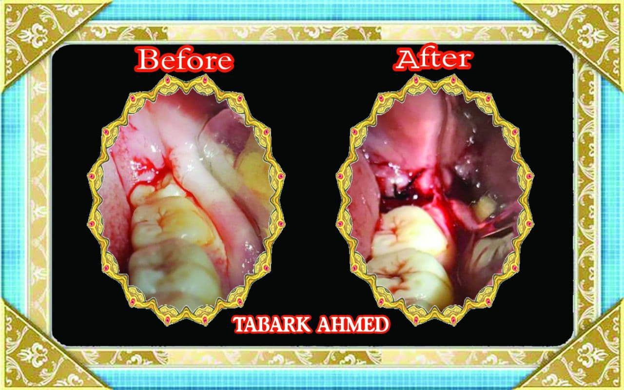 The excellence and creativity of the student, Tabarak Ahmed, in the process of extracting the wisdom tooth