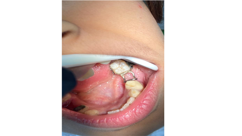 Part of the SPACE MAINTAINER work for a patient in the pediatric dental clinic.