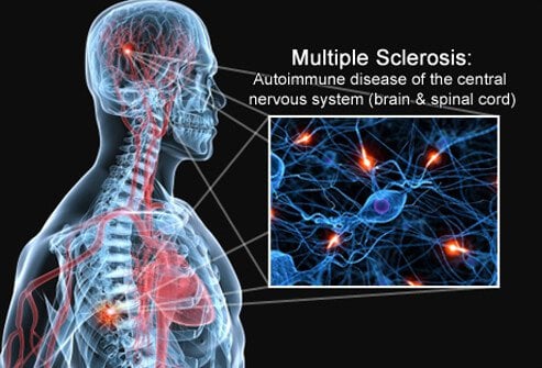 Multiple Sclerosis Scientific article By Dr.Aya Sabah Nore