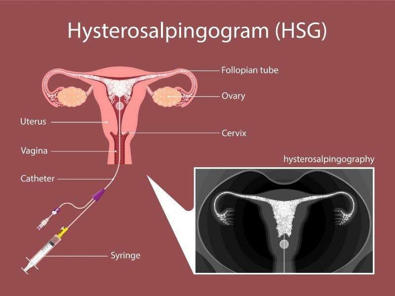Hysterosalpingography) د.احمد مظفر السعيدي  اخصائي الاشعه والسونار