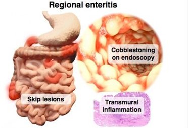 مقالة علمية في قسم تقنيات التخدير للتدريسية (م.م. عطاء خليل حسين) بعنوان (Crohn's disease (CD))
