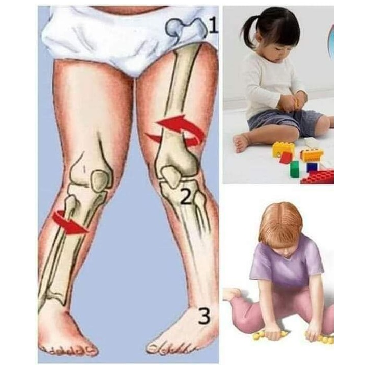مقالة بعنوان ( اصطكلك_الركبتين_genu_valgus ) للتدريسية م.د افتخار مطر باقر