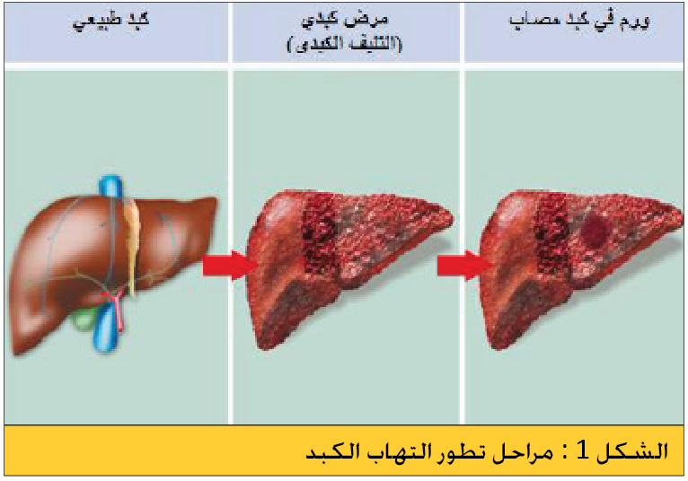 إلتهاب الكبد الوبائي
