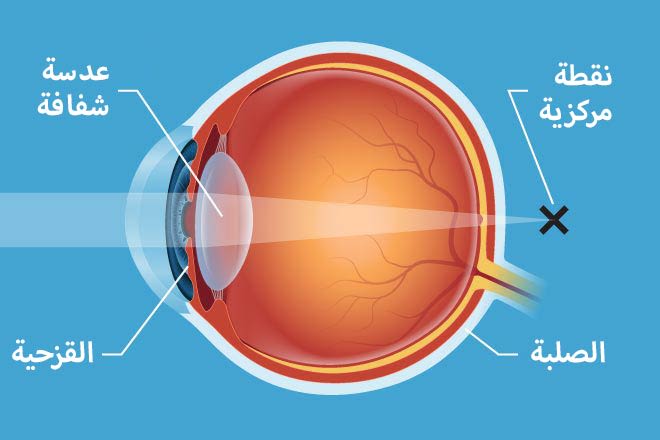 مقالة علمية للتدريسي مهيمن سمير عارف بعنوان (شرح للعدسات الزجاجيه والبلاستيكيه ومعامل الانكسار وعلاقته بسمك العدسات  )