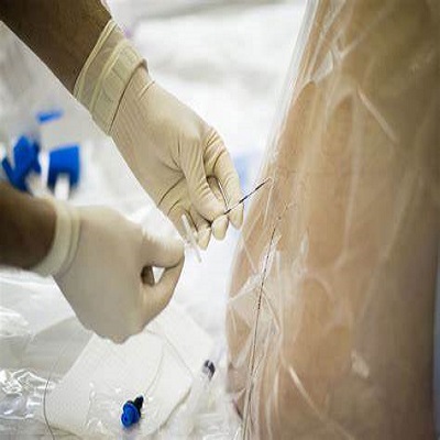 Unveiling the Wonders of Epidural Anesthesia