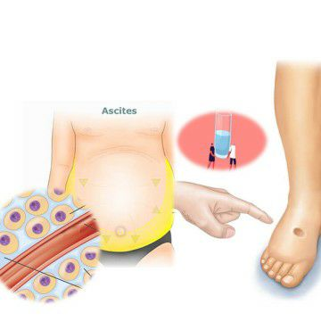 Scientific article on fluid retention in the body