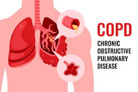 COPD in The Future of Iraqi Society