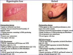 مقالة علمية للتدريسي م.م علي حسين النصرواي بعنوان (Keloids and Hypertrophic Scars)