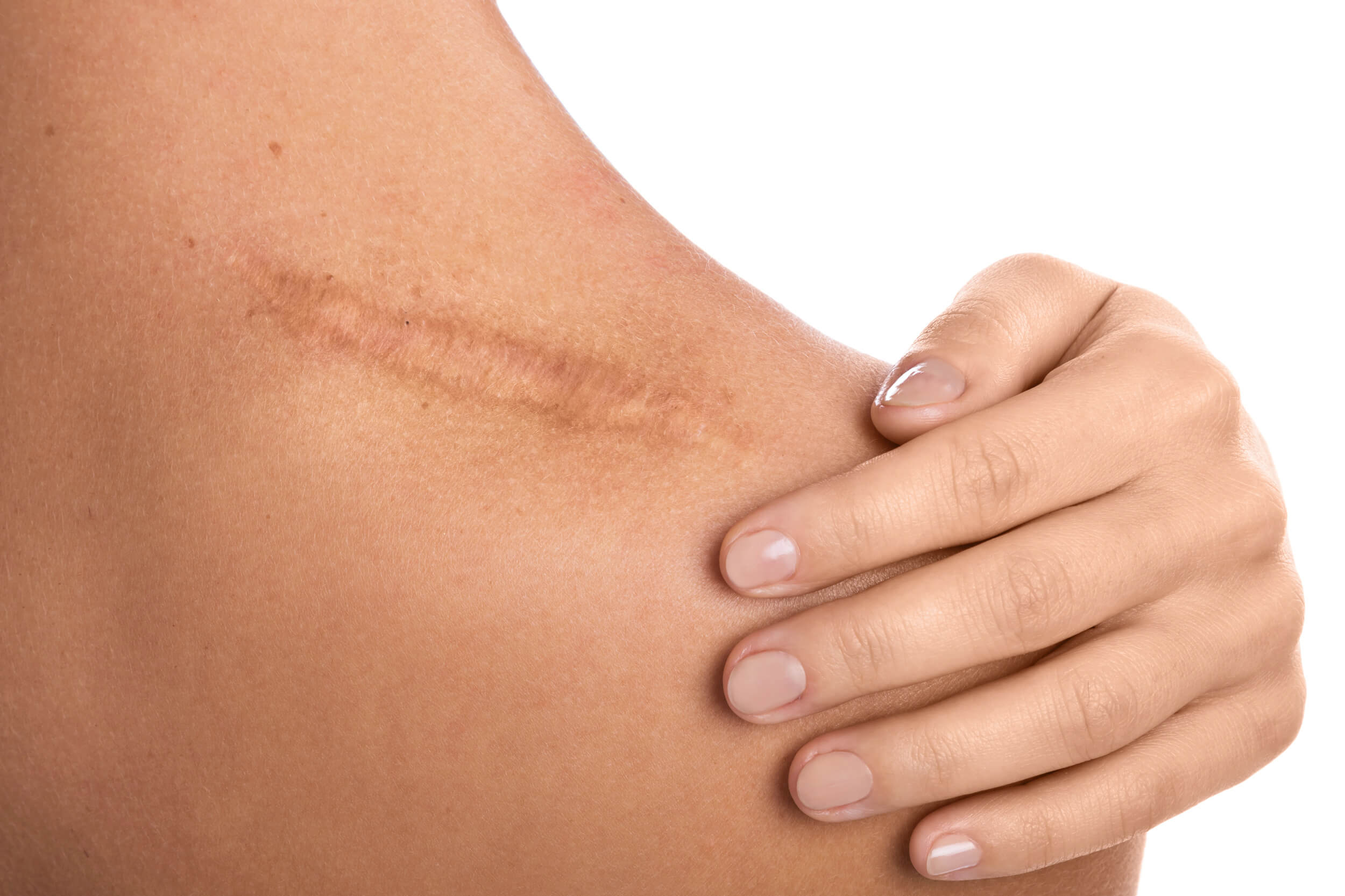 A scientific article by Lecturer M. M. Ali Hussein Al-Nasrawi entitled (Keloids and Hypertrophic Scars)