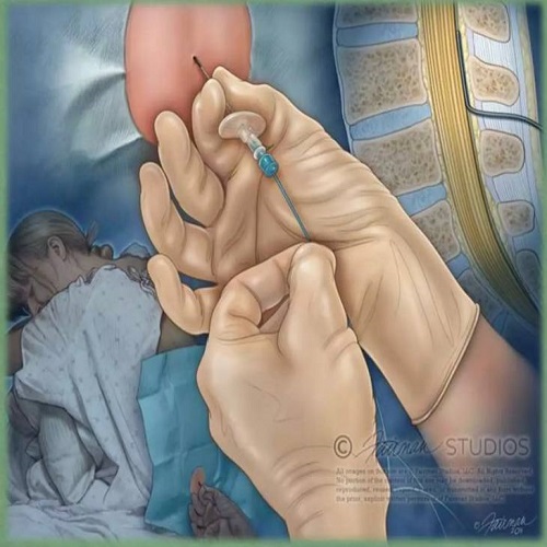 Painless birth