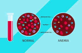 Iron deficiency anaemia