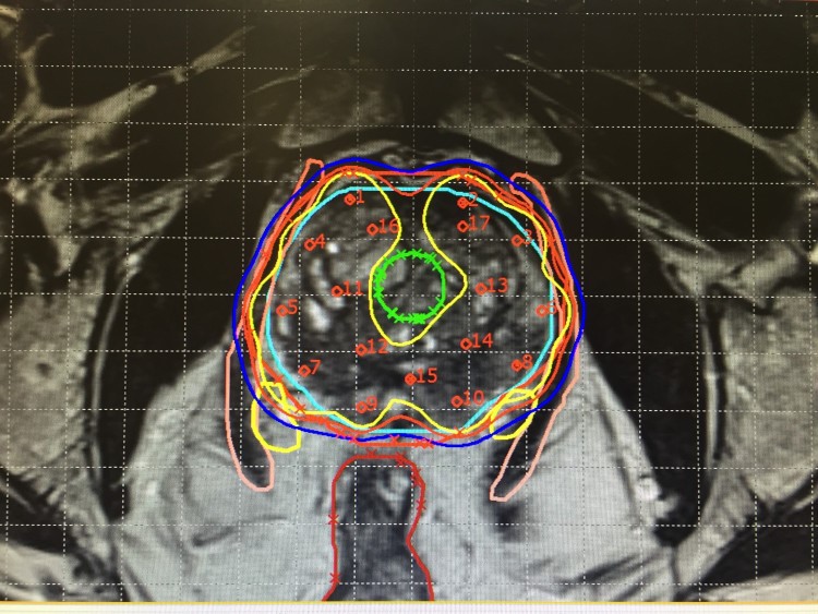  " دور التصوير الطبي في العلاج الإشعاعي " بقلم التدريسي مصطفى كامل الشمري 
