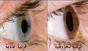  ما هي القرنية المخروطية مقالة علمية للسيدة سارة عباس مسلم 