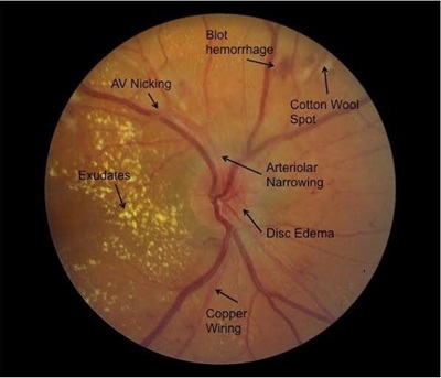 Scientific article by Dr. Nilufer Ali  (The eye in hypertension ) 