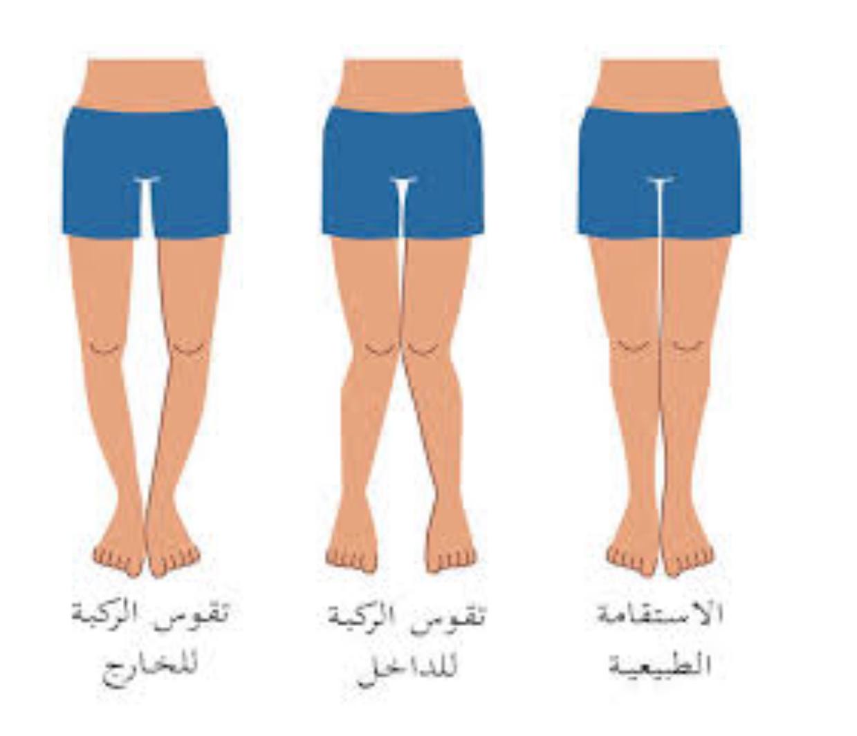 An article about rickets by lecturer Elaf Ali Obaid
