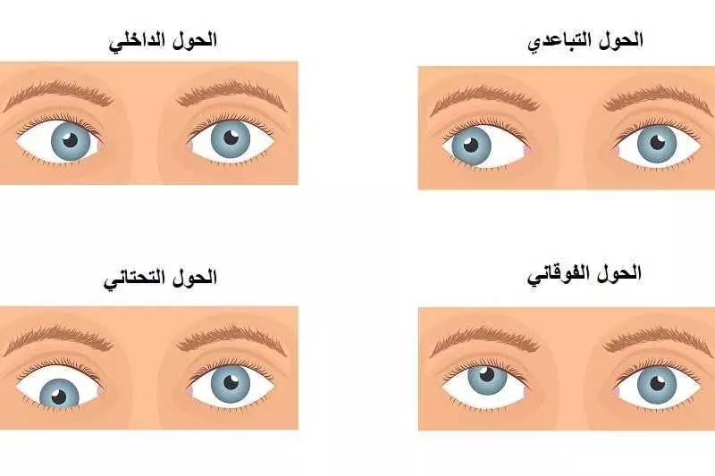 مقالة علمية بعنوان الحول لدى الاطفال للمعيدة ست زهراء عباس علي 