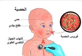 الحصبة