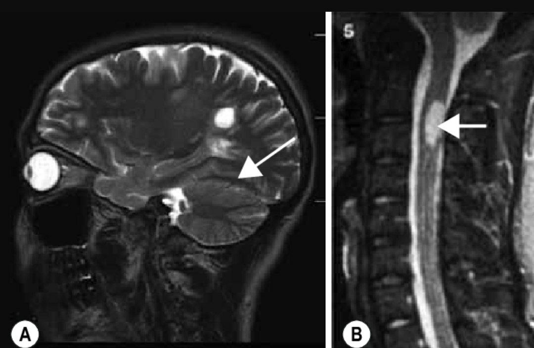 مقالة علمية للمعيدة سراب مسلم حسن بعنوان "التصلب اللويحي | Multiple Sclerosis (MS)"
