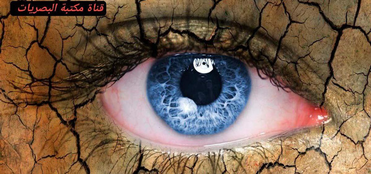 A scientific article by the teacher Muhaymen Samir Arif entitled (Dry Eyes)