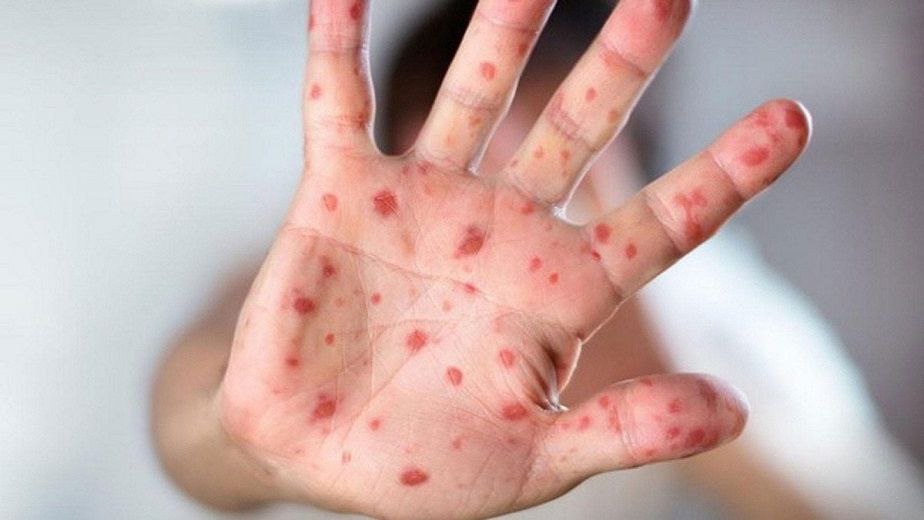 مقالة بعنوان " جدري القردة Monkey Pox"