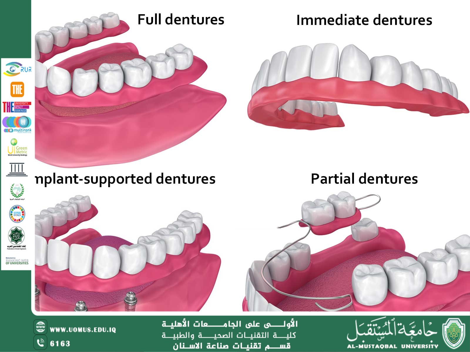 نوع طقم الأسنان الكامل