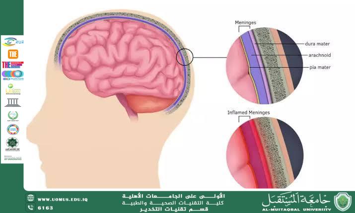 مقالة علمية للاستاذ حسن ناجح حول التهاب السحايا (Meningitis)