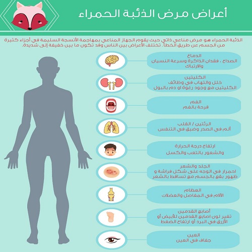 الذئبة الحمراء