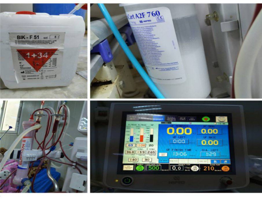 مقالة علمية بعنوانwhat is the haemodialysis and how is the transaction done للمهندس محمد عبدالكريم رزوقي