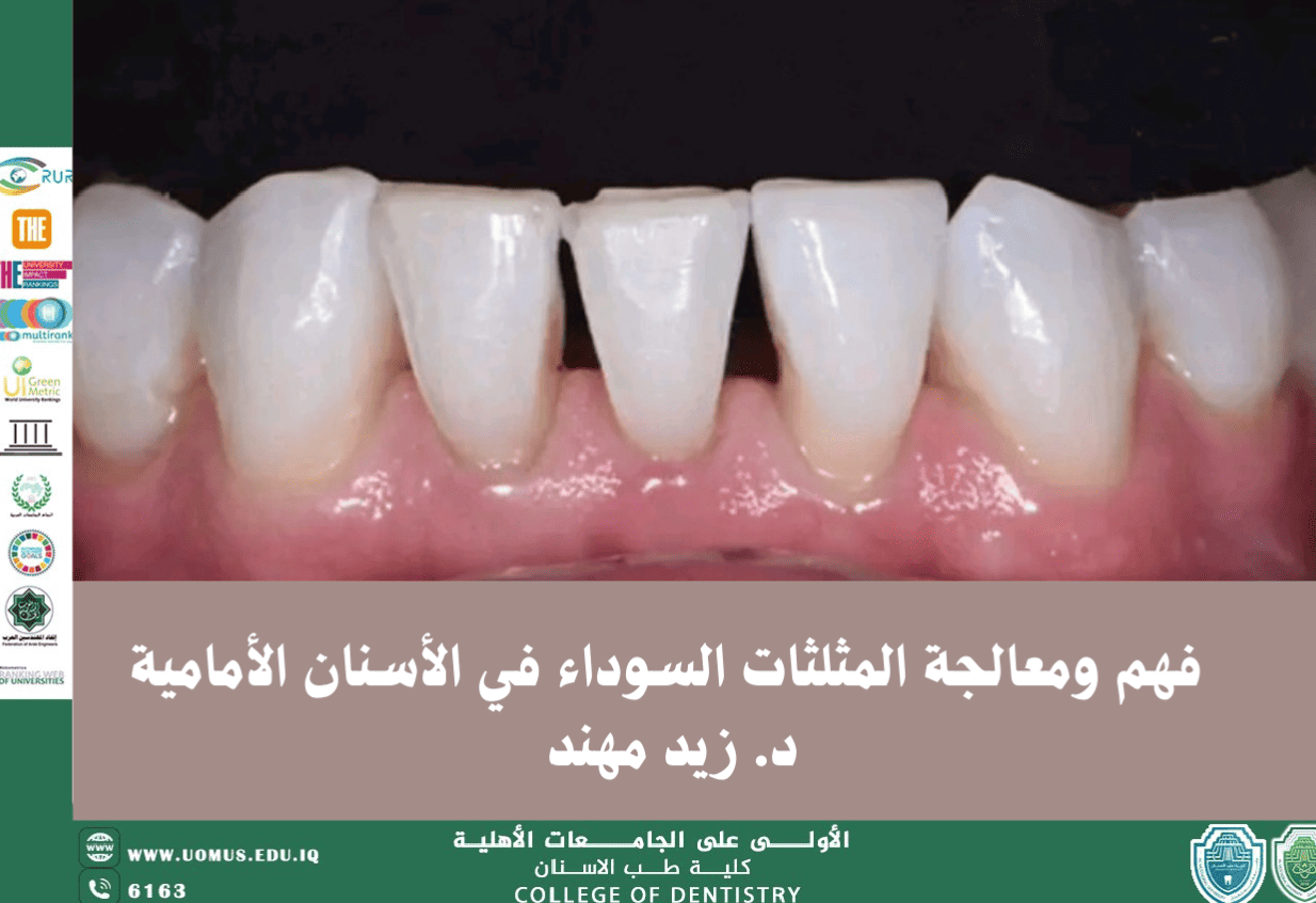مقال علمي للدكتور زيد مهند عن فهم ومعالجة المثلثات السوداء في الأسنان الأمامية