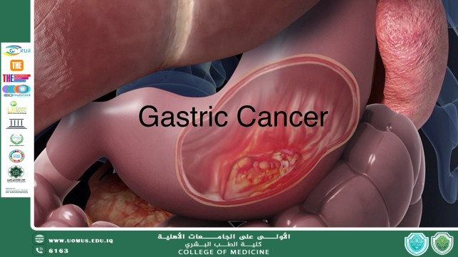 مقالة بعنوان سرطان المعدة