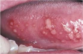 مقالة علمية بعنوان (Aphthous Ucer  ) 