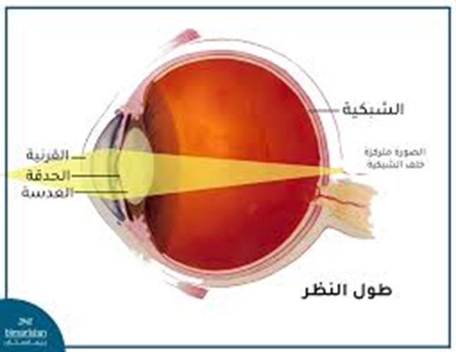 مقالة علمية للمعيدة تمارا نهاد عباس بعنوان( دور العدسة المحدبة في تصحيح بعد النظر). 