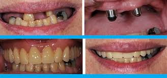 مقالة علمية بعنوان ( telescopic overdenture ) 