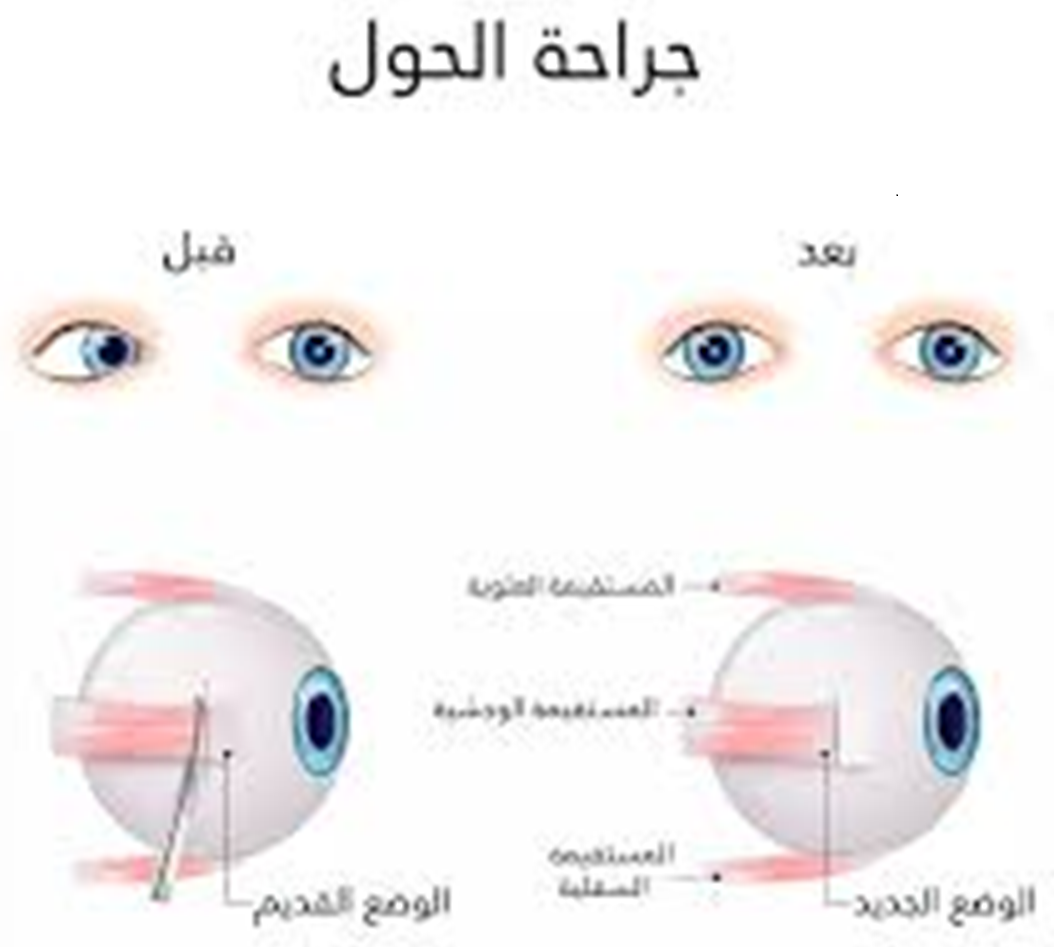 مقالة للمعيدة زهراء عباس علي بعنوان(الحول الوحشي).