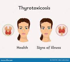 Understanding Hyperthyroidism: Symptoms and Implications by dr zainab ali 