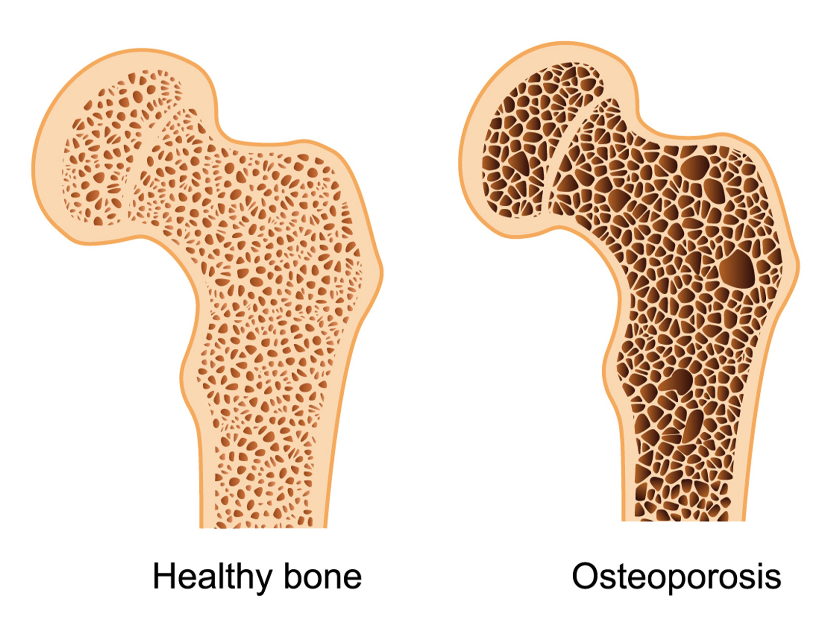 مقالة علمية للاستاذ الدكتور ( منى صالح مرزة ) بعنوان ( Osteoporosis: A Comprehensive Overview)