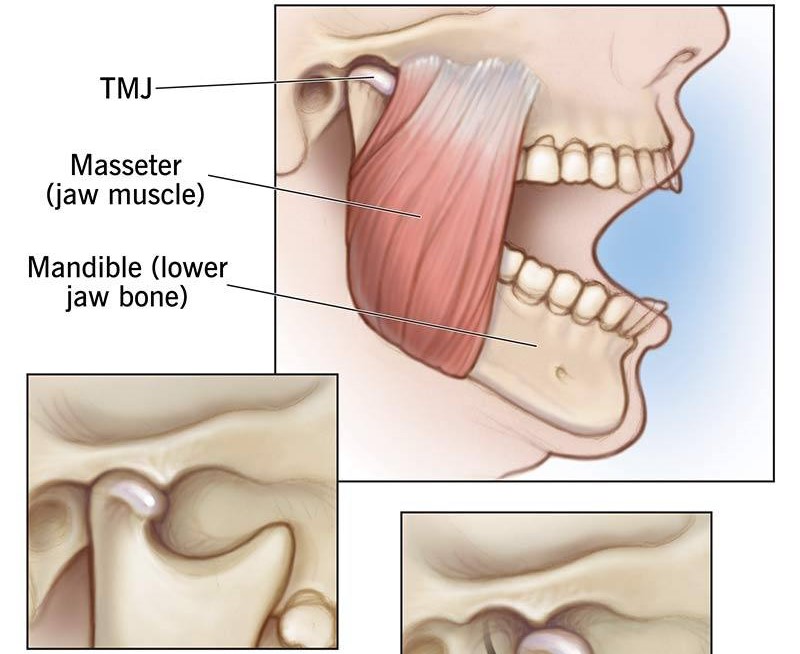 مقالة حول (TMJ) Disorders