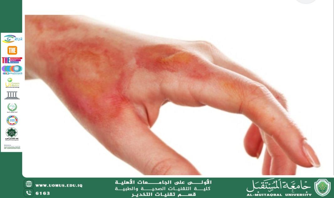 الحروق