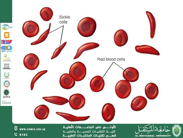 مقالة علمية للسيدة رفيف صفاء هادي فقر الدم المنجلي 