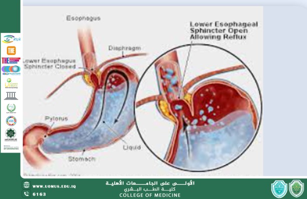 مقالة بعنوان  مرض الارتجاع المعدي المريئي (GERD) وتأثيره على الجهاز التنفسي العلوي